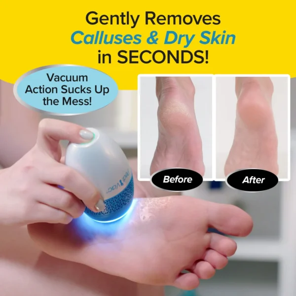 Rechargeable Electric Foot File for Feet with Built-in Vacuum Pedi Vac Callus Remover Removes Dead Skin on Feet - Image 4